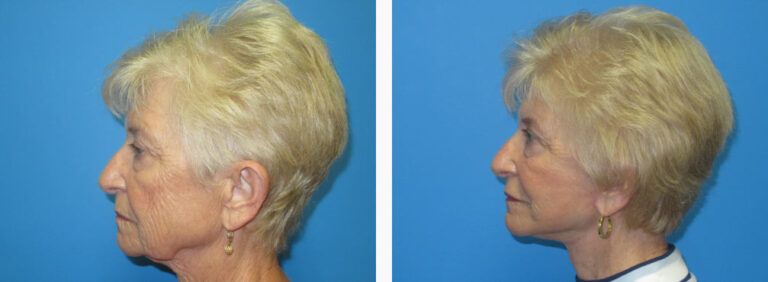 Facelift before and after treatment