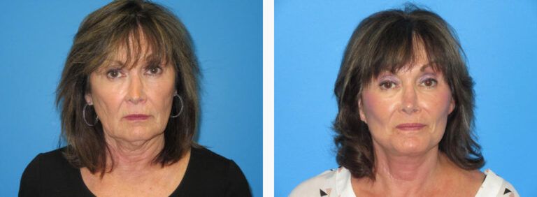 Facelift before and after treatment