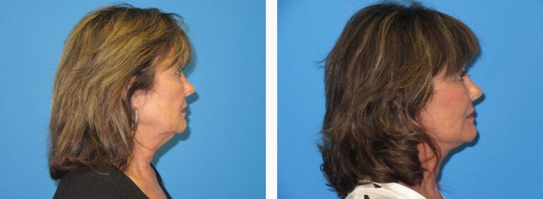 Facelift before and after treatment
