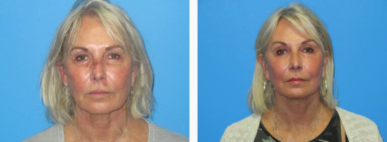 Facelift before and after treatment