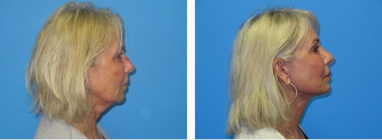 Facelift before and after treatment