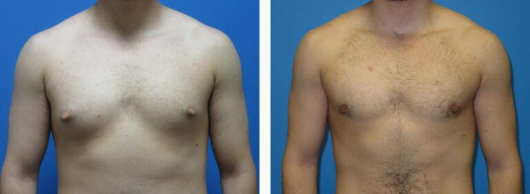 Gynecomastia before and after treatment