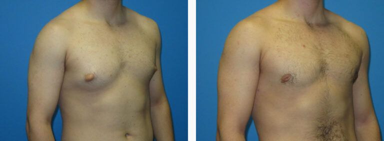 Gynecomastia before and after treatment