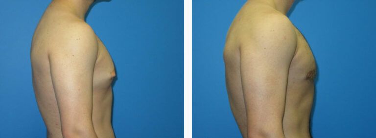 Gynecomastia before and after treatment