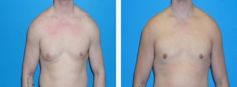 Gynecomastia before and after treatment