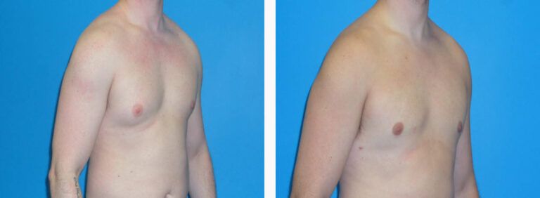 Gynecomastia before and after treatment