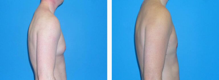 Gynecomastia before and after treatment