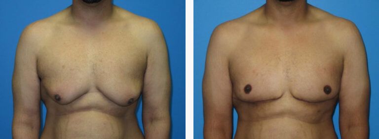Gynecomastia before and after treatment