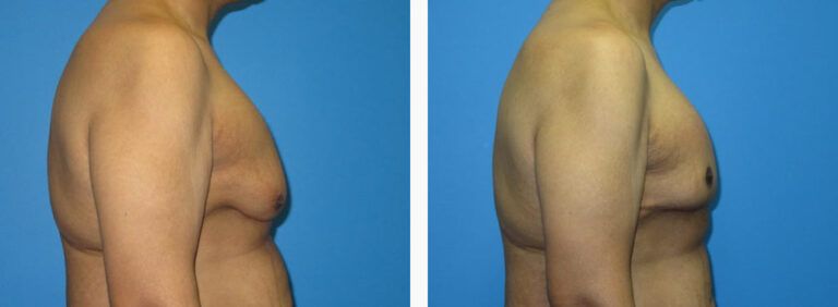 Gynecomastia before and after treatment