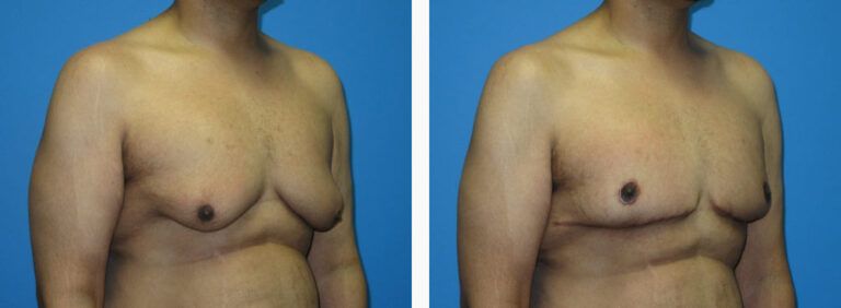 Gynecomastia before and after treatment