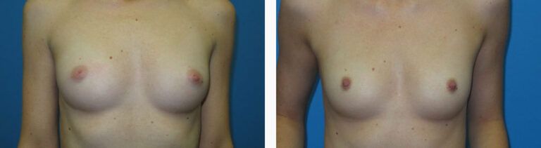 Inverted Nipple Repair before and after treatment