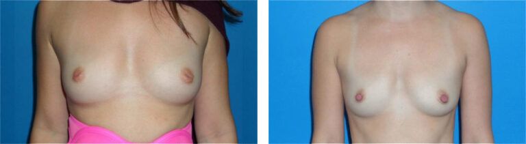 Inverted Nipple Repair before and after treatment