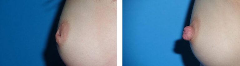 Inverted Nipple Repair before and after treatment
