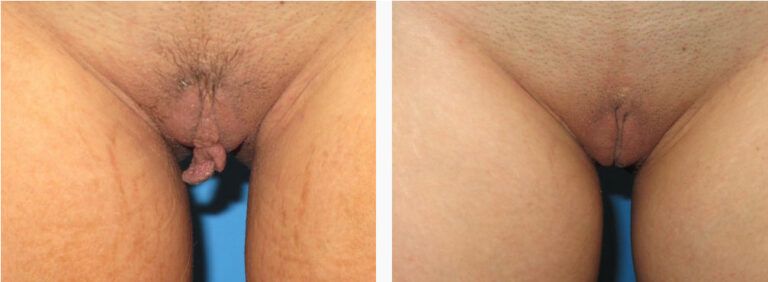 Labiaplasty before and after treatment
