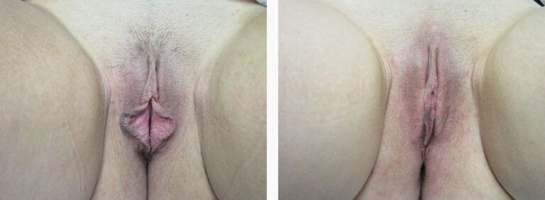 Labiaplasty before and after treatment