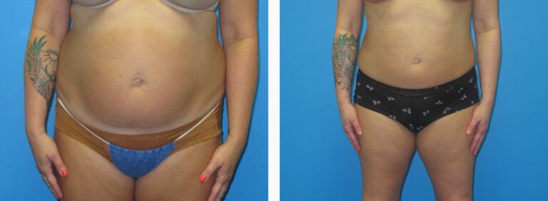Liposuction before and after treatment