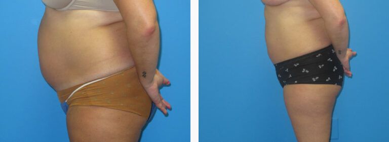 Liposuction before and after treatment