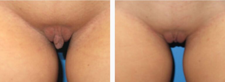 Labiaplasty before and after treatment