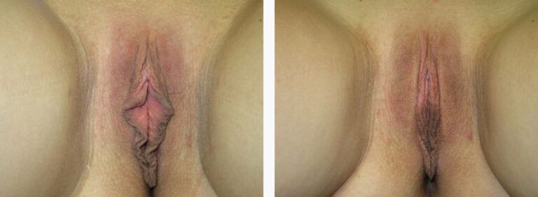 Labiaplasty before and after treatment