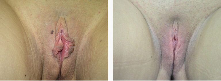 Labiaplasty before and after treatment