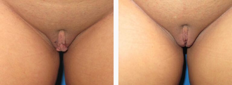 Labiaplasty before and after treatment