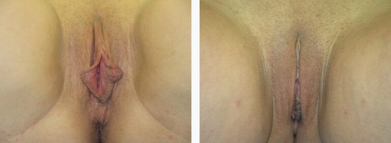 Labiaplasty before and after treatment