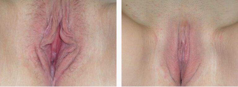 Labiaplasty before and after treatment