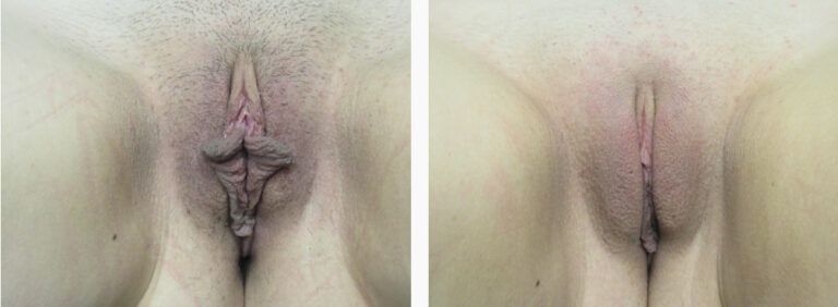 Labiaplasty before and after treatment