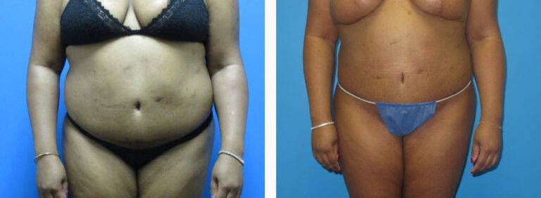 Liposuction before and after treatment