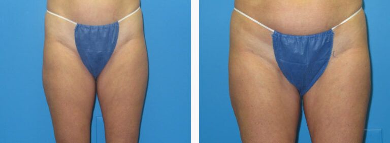 Liposuction before and after treatment