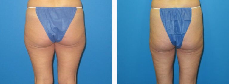 Liposuction before and after treatment
