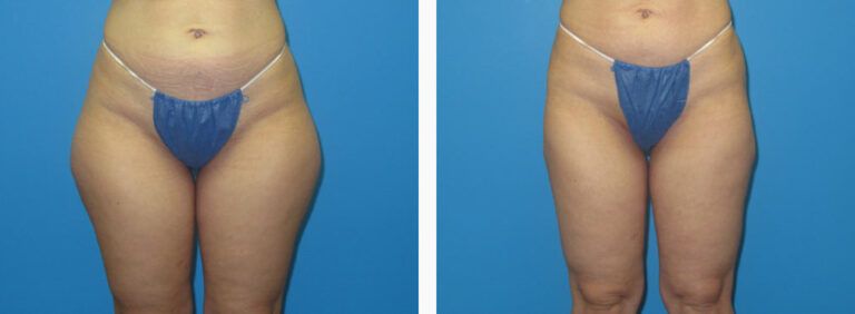 Liposuction before and after treatment