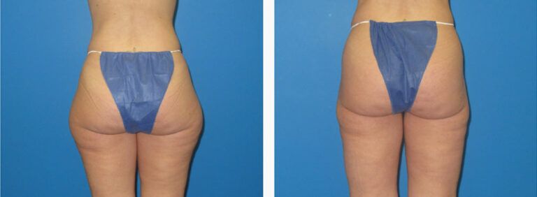 Liposuction before and after treatment