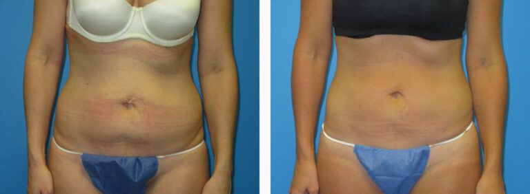 Liposuction before and after treatment