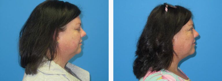 Liposuction before and after treatment