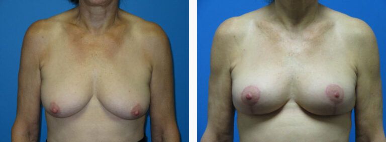 Mastopexy before and after treatment