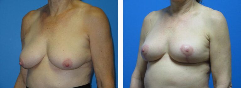 Mastopexy before and after treatment