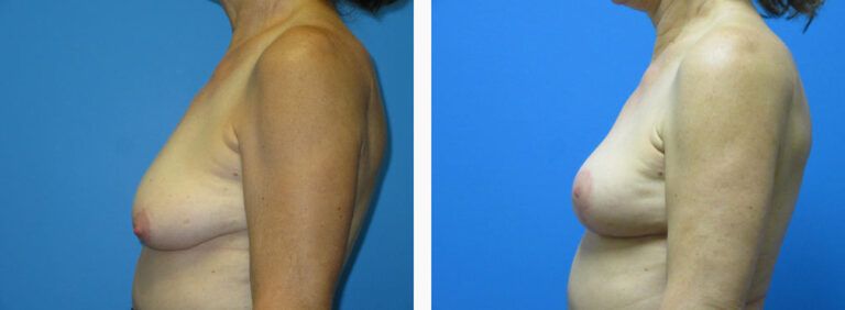 Mastopexy before and after treatment