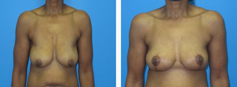 Mastopexy before and after treatment