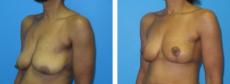 Mastopexy before and after treatment