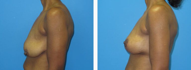 Mastopexy before and after treatment