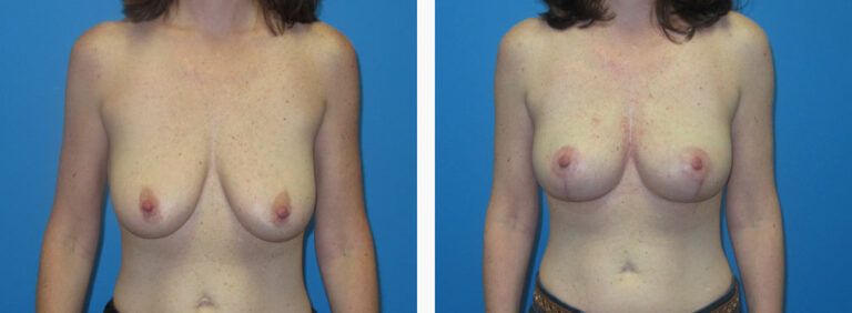 Mastopexy before and after treatment