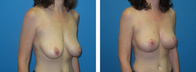 Mastopexy before and after treatment