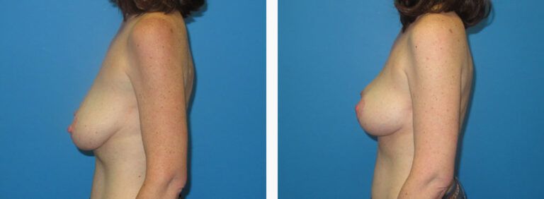 Mastopexy before and after treatment