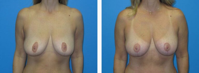 Mastopexy before and after treatment