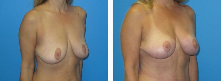 Mastopexy before and after treatment