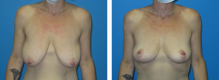 Mastopexy before and after treatment
