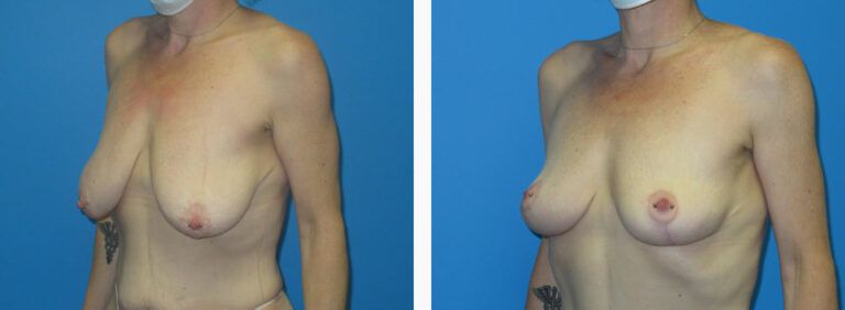 Mastopexy before and after treatment