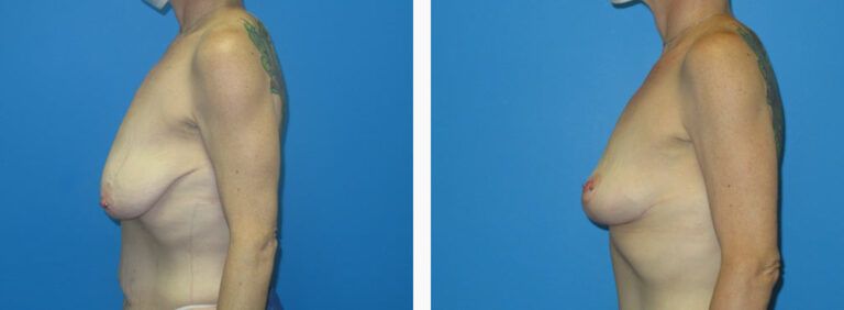 Mastopexy before and after treatment