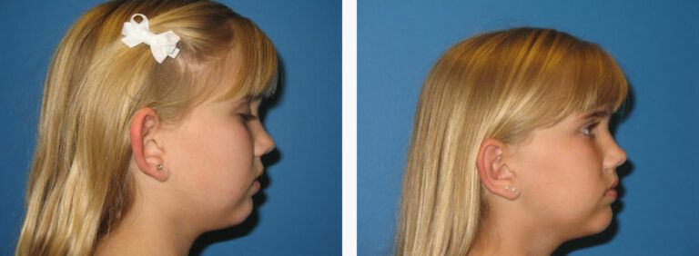 Otoplasty before and after treatment